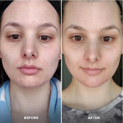 Before and After difference of using an Ice Face Roller 2